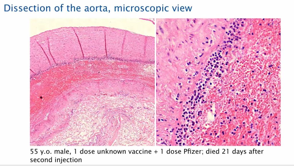Aorta Dissection Post Covid19 Vaccination 1024x579