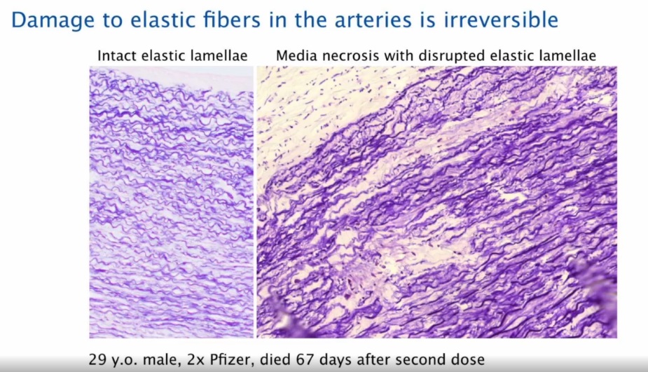 Damage Elastic Fibers In Arteries Post Covid19 Vaccination