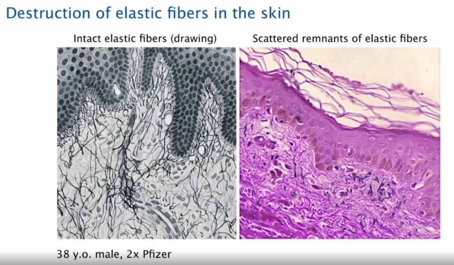 Destruction Of Elastic Fibers In Skin Post Covid19 Vaccination