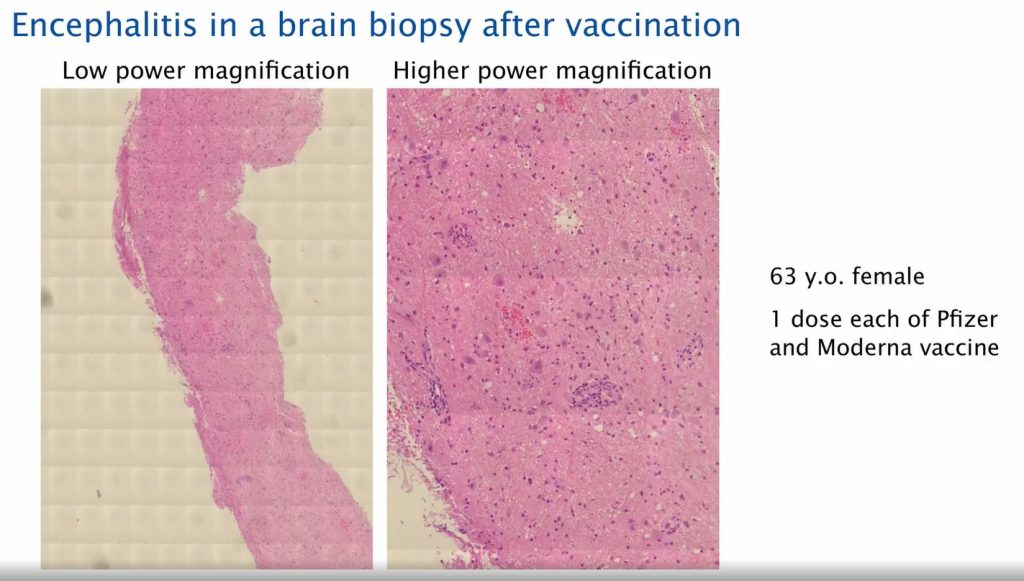 Encephalitis In Brain Biopsy Post Covid19 Vaccination 1024x581