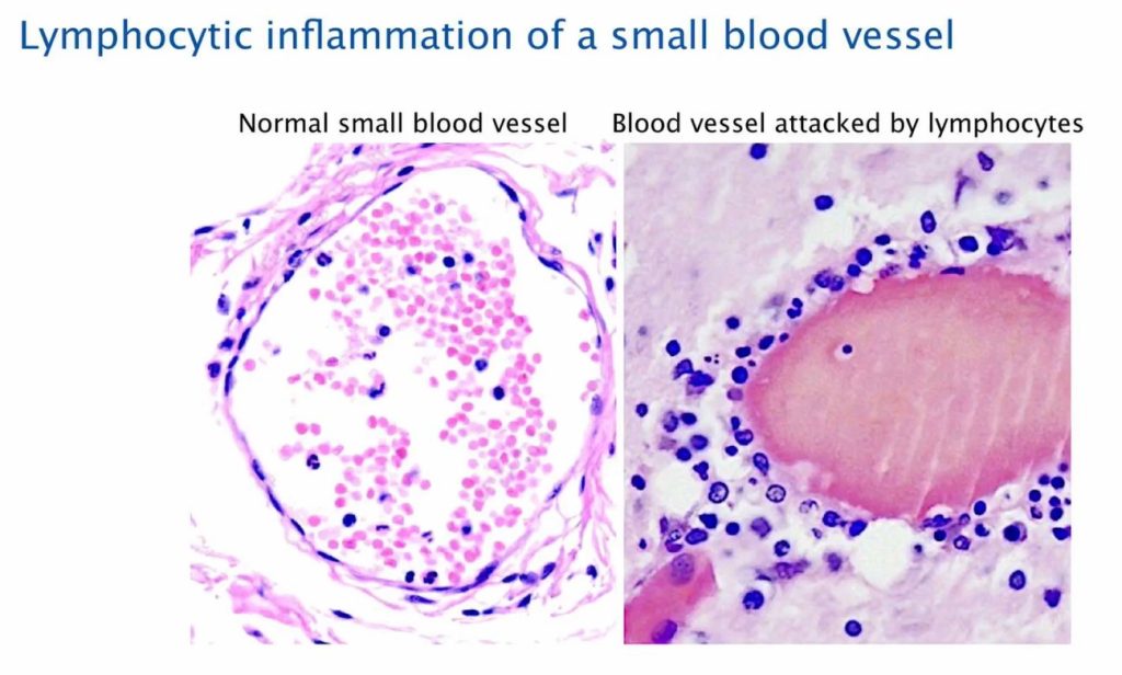 Lymphocytic Inflammation Of A Small Bloodvessel 1024x616