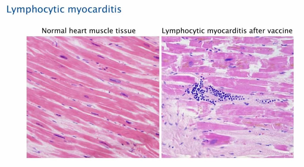 Lymphocytic Myocarditis 1 1024x564