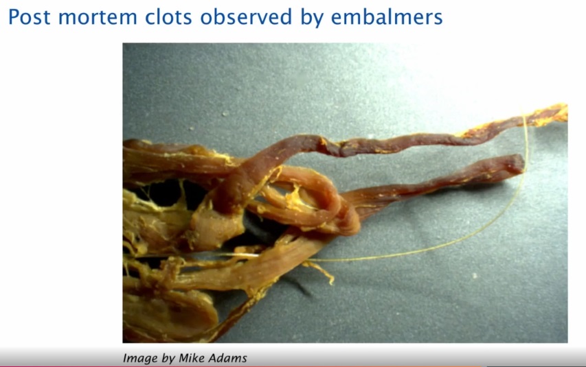 Post Mortem Clots After Covid19 Vaccination