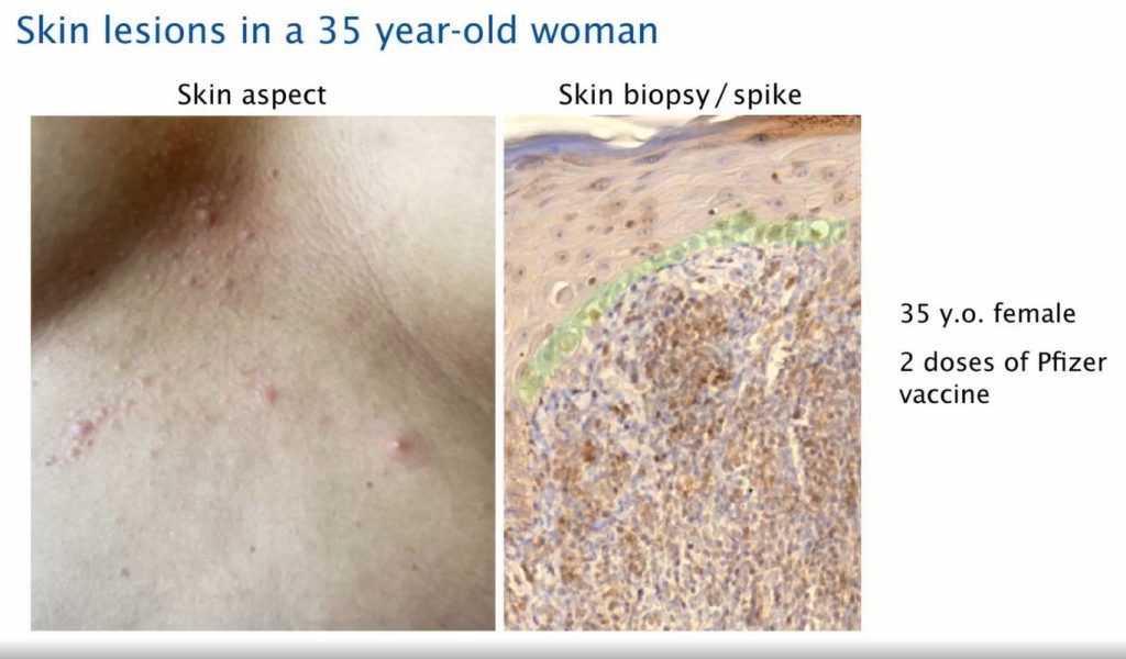 Skin Lesions Spike Protein Expression Post Covid19 Vaccination 1024x600