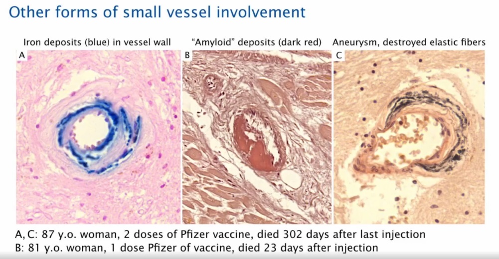 Small Vessel Histopathology Post Covid19 Vaccination