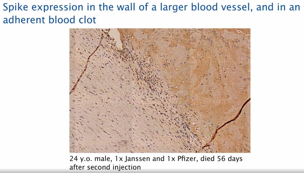 Spike Expression Blood Vessel Post Covid19 Vaccination 1024x583