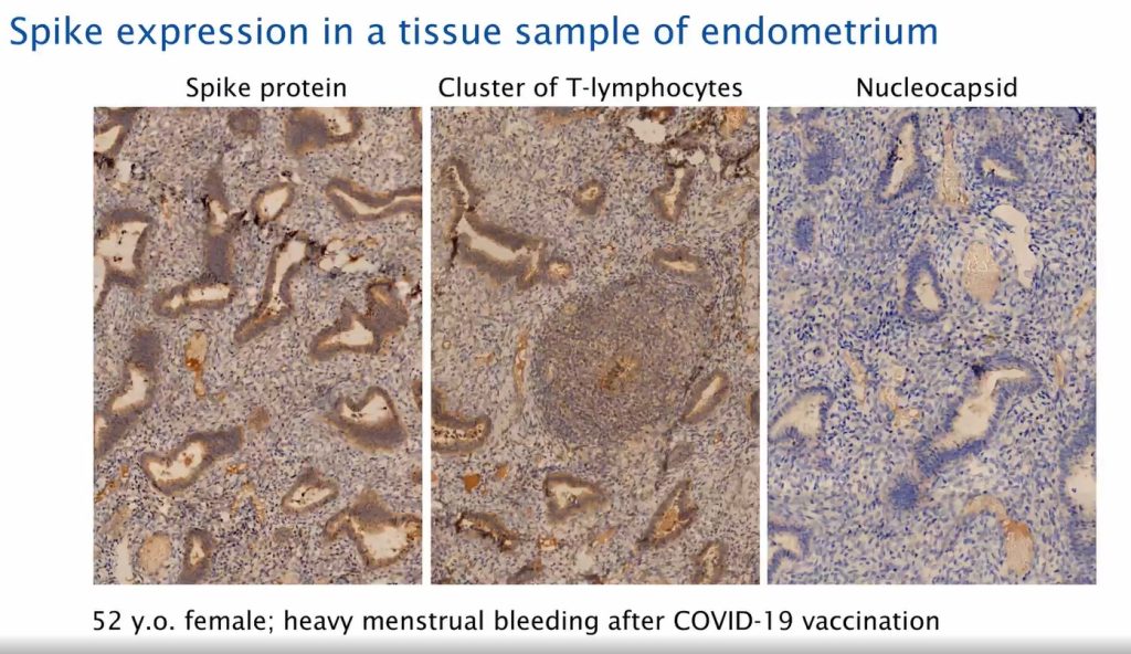 Spike Expression Endometrium Post Covid19 Vaccination 1024x592