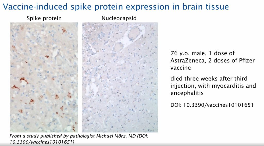 Spike Expression In Brain Tissue Post Covid19 Vaccination 1024x568