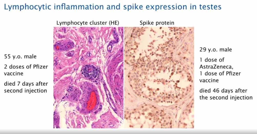 Spike Expression In Testes Post Covid19 Vaccination