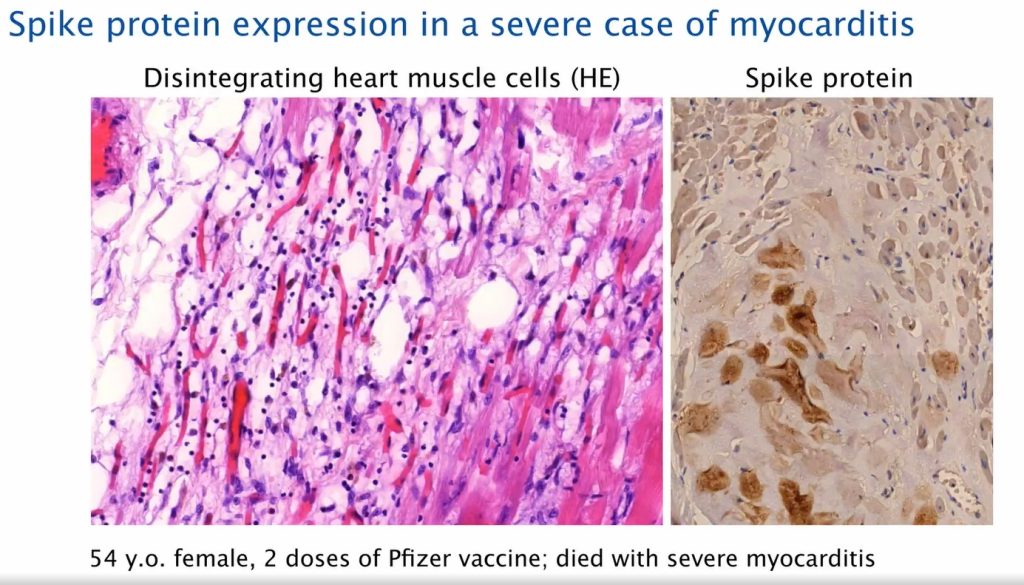 spike expression severe myocarditis post covid19 vaccination