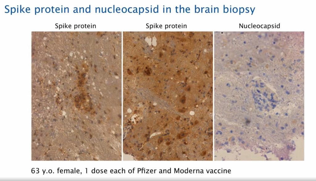 spike proteïn and nucleocapsid in brain biopsy post covid19 vaccination