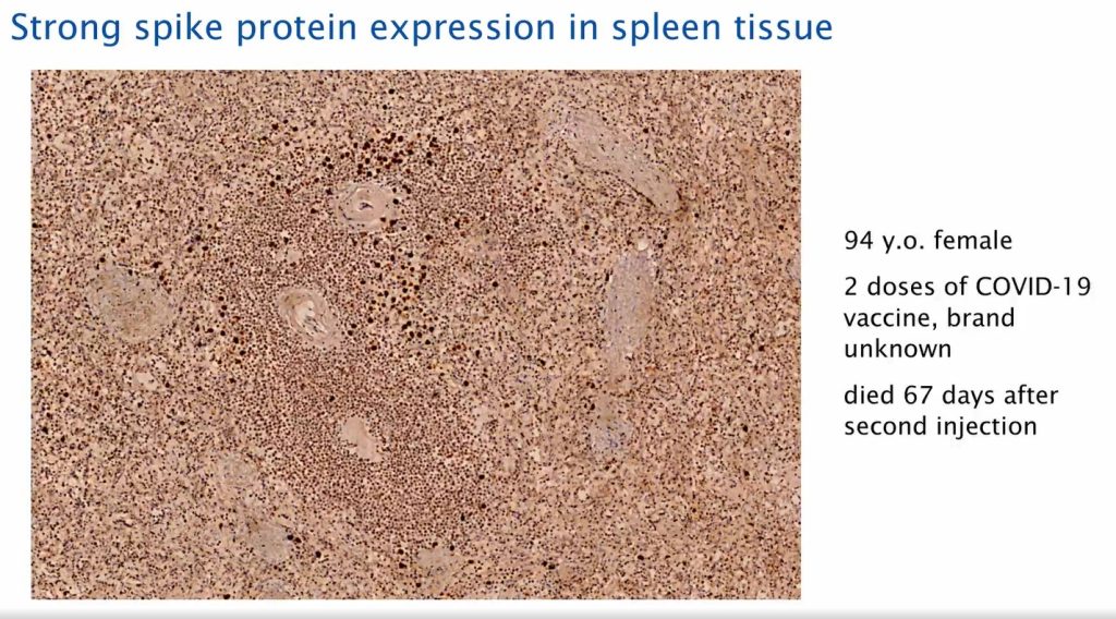strong spike proteïn expression in spleen tissue post covid19 vaccination