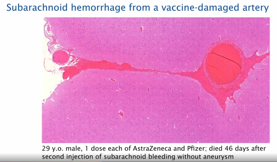 subarachnoid hemorrhage post covid19 vaccination