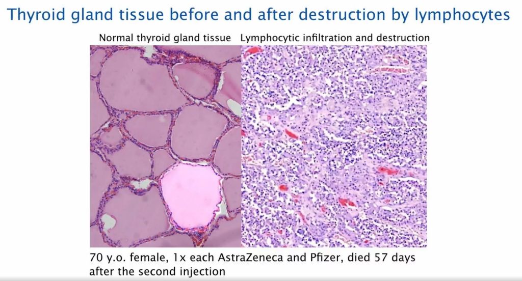 thyriod gland tissue inflammation post covid19 vaccination