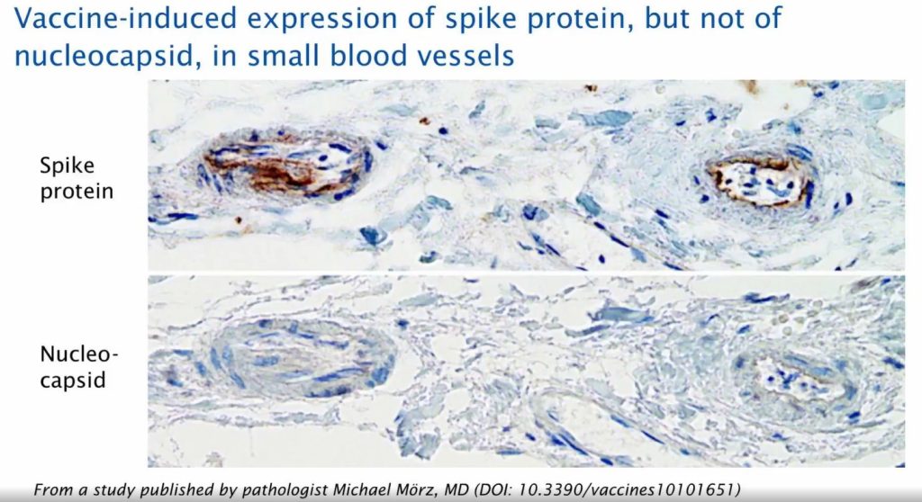vaccine induced expression of spike proteïn post covid19 vaccination