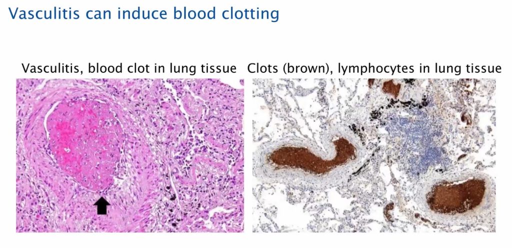 vasculitis can induce blot clotting